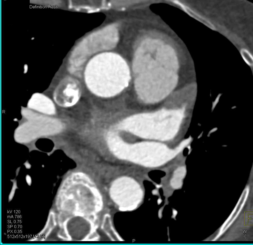 Pseudoclot in the Left Atrial Appendage - CTisus CT Scan