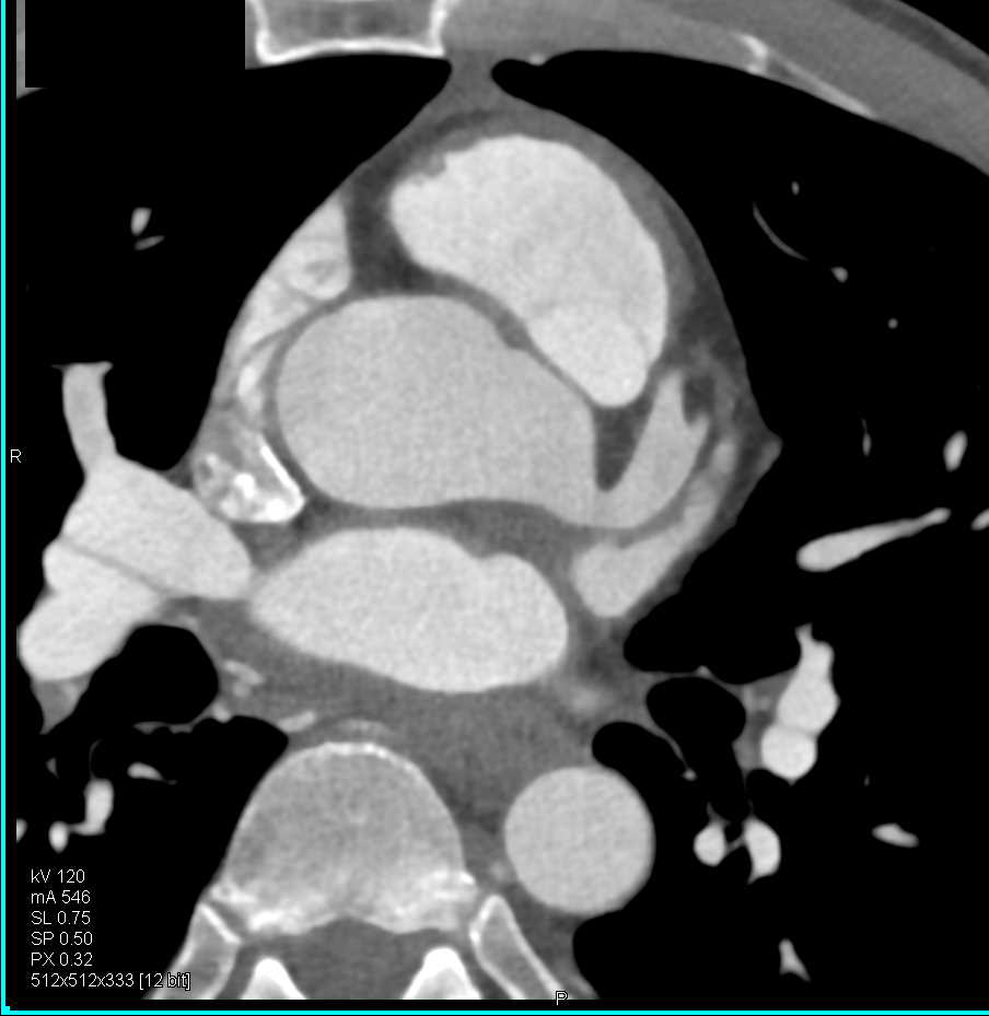 CCTA with Aneurysm of the Left Main Coronary Artery - CTisus CT Scan