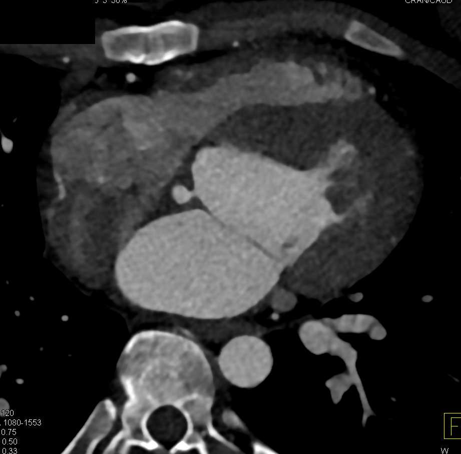 Pseudoaneurysm off the Left Ventricle - CTisus CT Scan