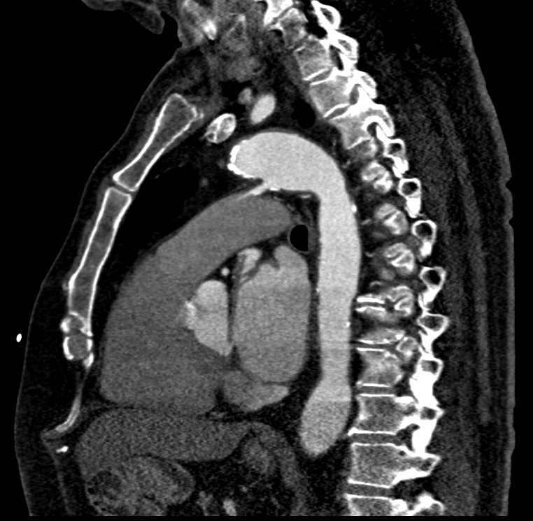 PDA (Patent Ductus Arteriosus) - CTisus CT Scan
