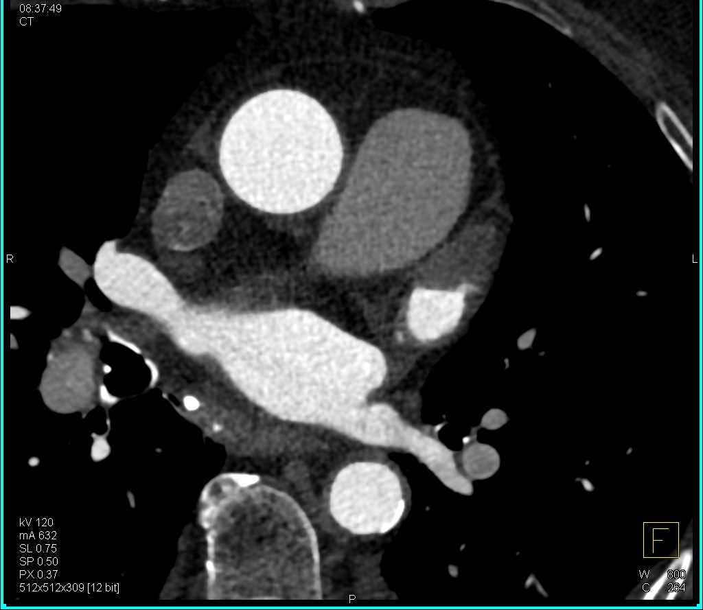Pseudothrombus in the Left Atrial Appendage - CTisus CT Scan