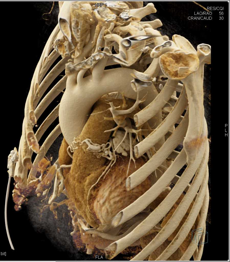 CCTA: Coronary Artery Fistulae to the Pulmonary Artery with Cinematic Rendering - CTisus CT Scan
