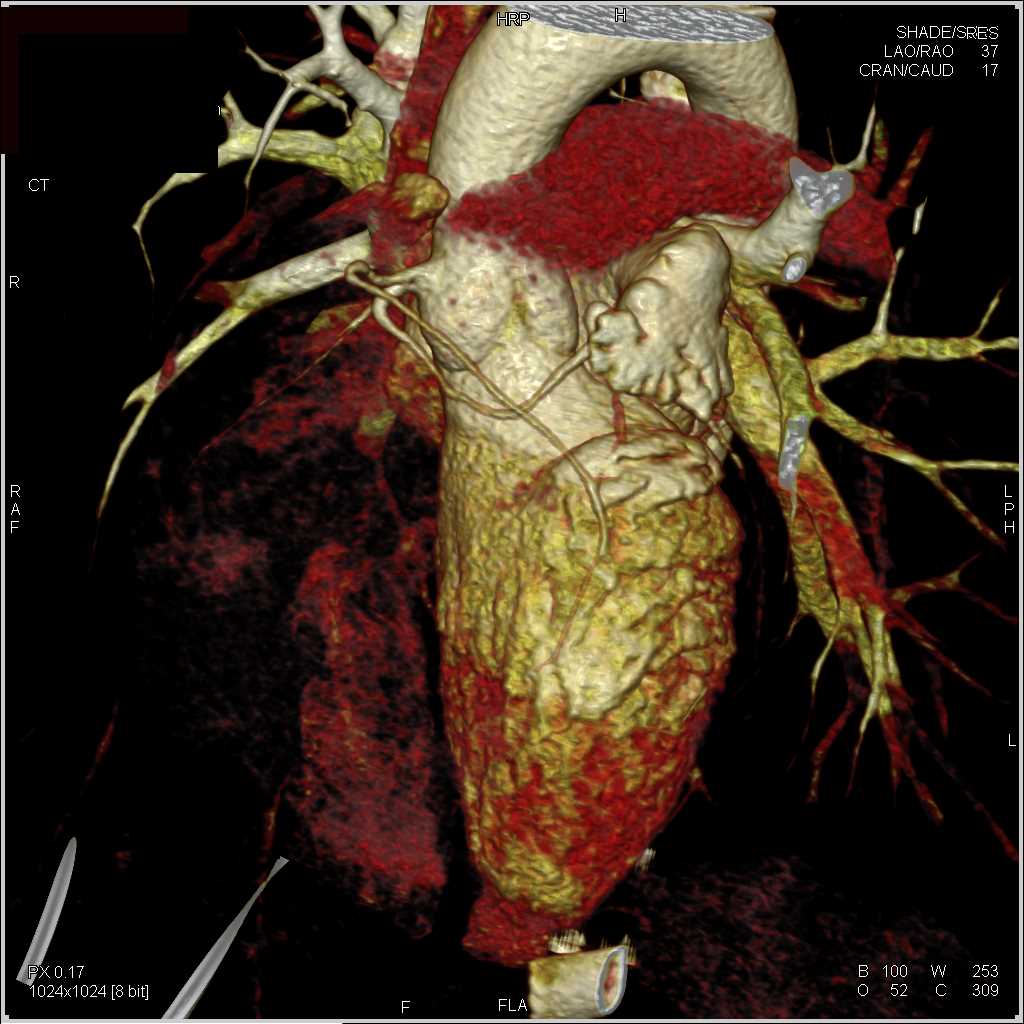 Anomalous Coronary Artery and Normal Left Atrial Appendage - CTisus CT Scan
