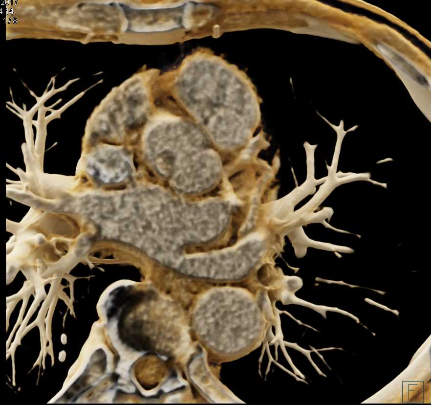 Papillary Fibroelastoma off the Aortic Valve - CTisus CT Scan