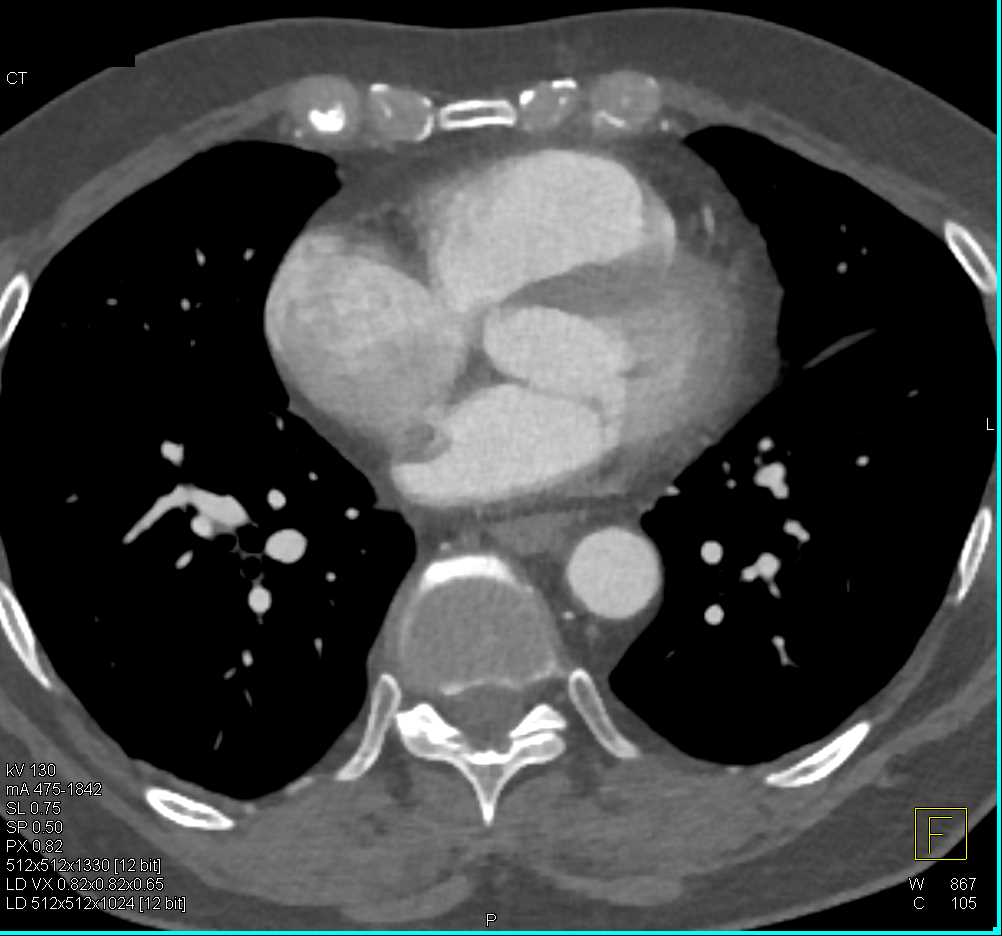Thrombus in the Left Atrium - CTisus CT Scan