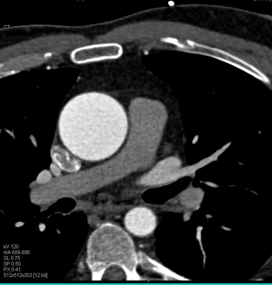 Bicuspid Aortic Valve and Dilated Ascending Aorta - CTisus CT Scan