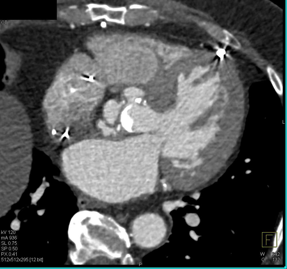 CTisus CT Scanning | Outpouching Aortic Root near AVR