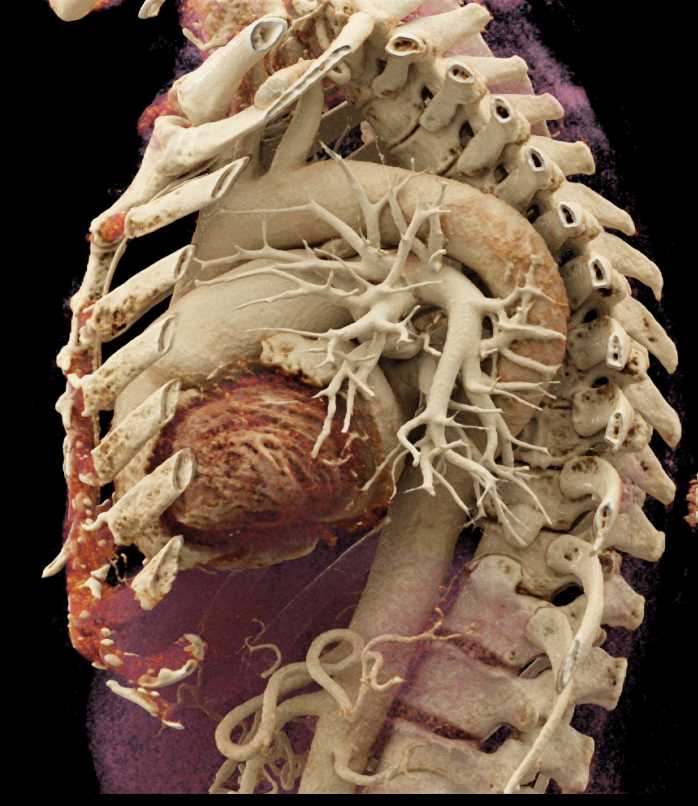 Patent Ductus Arteriosus (PDA) with Cinematic Rendering - CTisus CT Scan