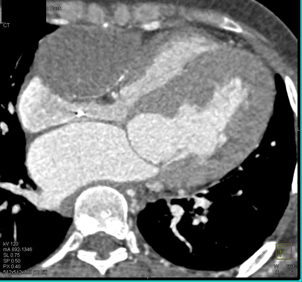 Angiosarcoma Involves the Right Side of the Heart - CTisus CT Scan