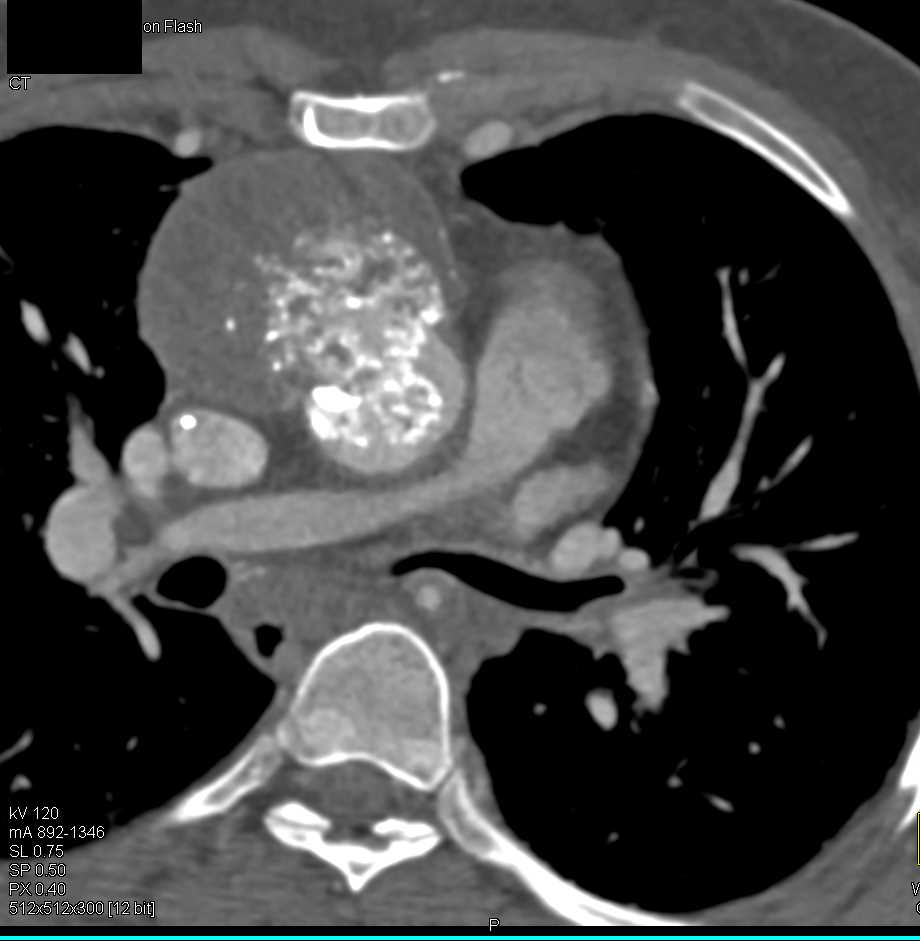 Angiosarcoma Involves the Right Side of the Heart - CTisus CT Scan