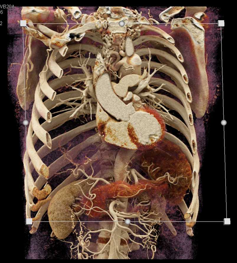 Coarctation of the Aorta with Multiple Collaterals - CTisus CT Scan