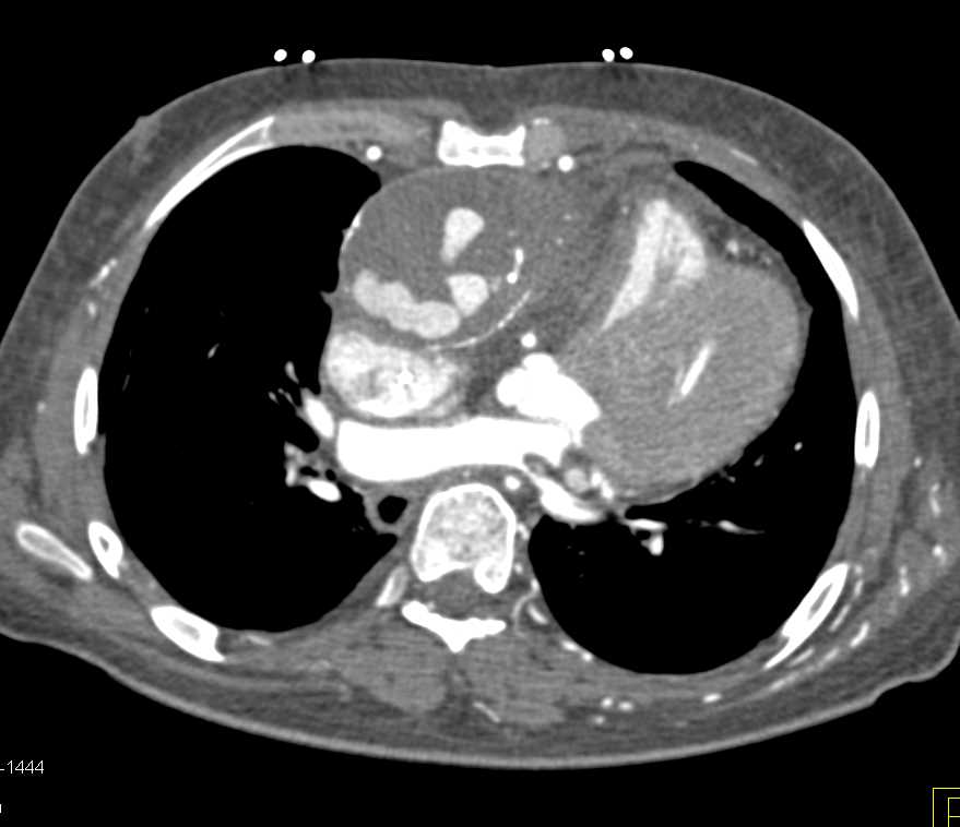 Bleed from Ascending Aorta Repair - CTisus CT Scan
