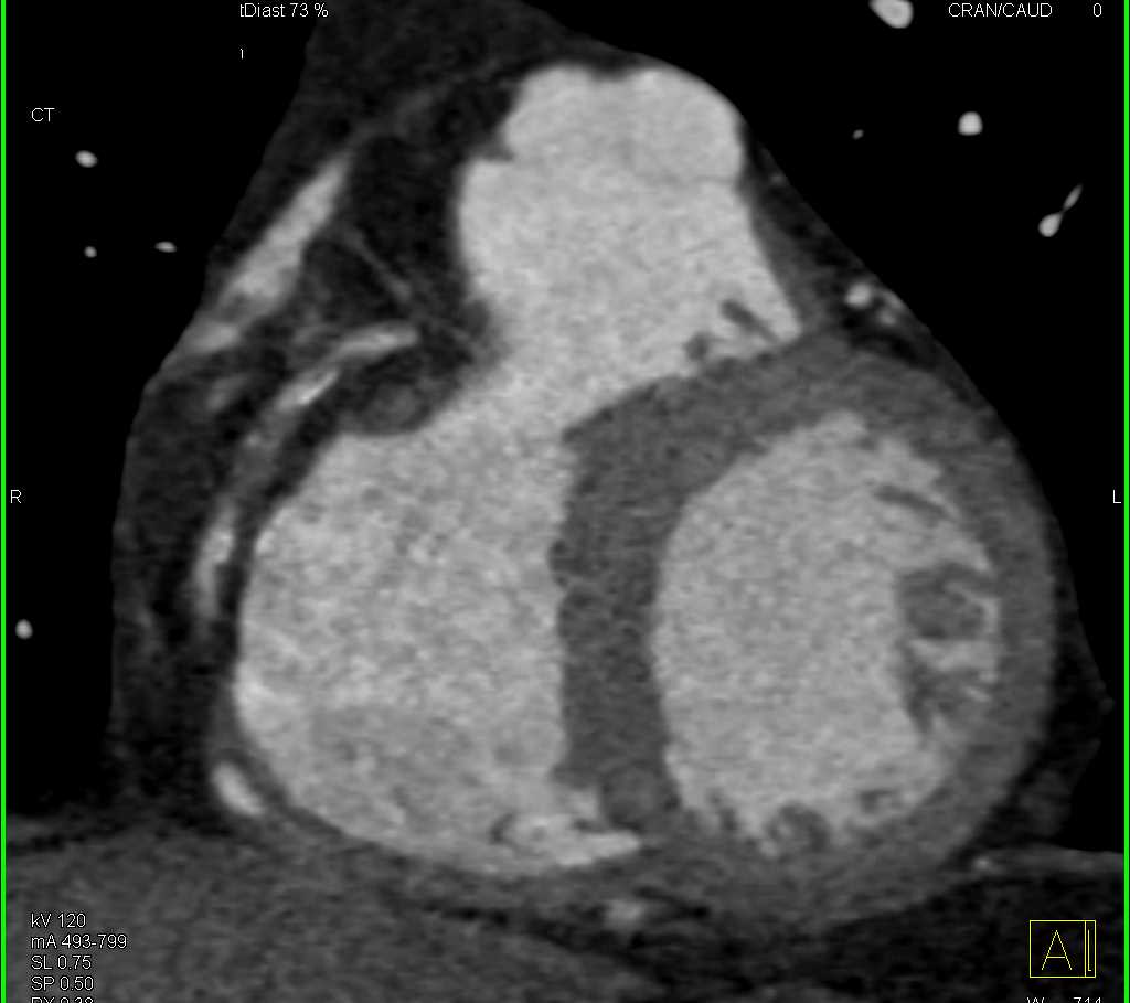 CCTA with Occluded Right Coronary Artery (RCA) - CTisus CT Scan