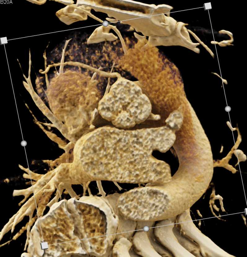 4 Cusps to Aortic Valve or Quadricuspid aortic valve - CTisus CT Scan