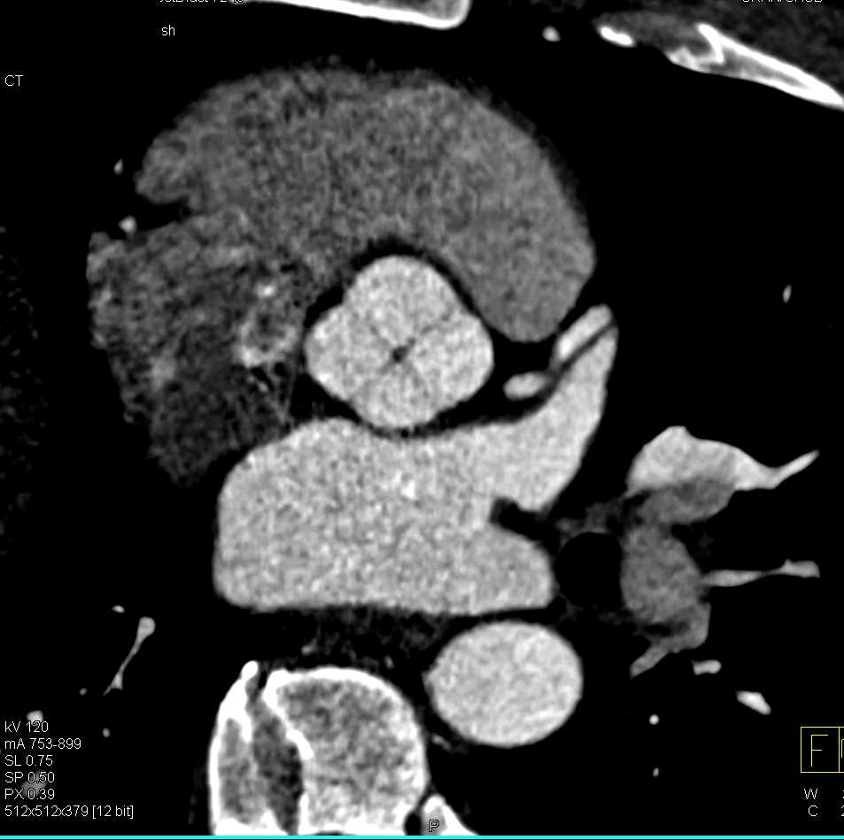 4 Cusps to Aortic Valve or Quadricuspid aortic valve - CTisus CT Scan