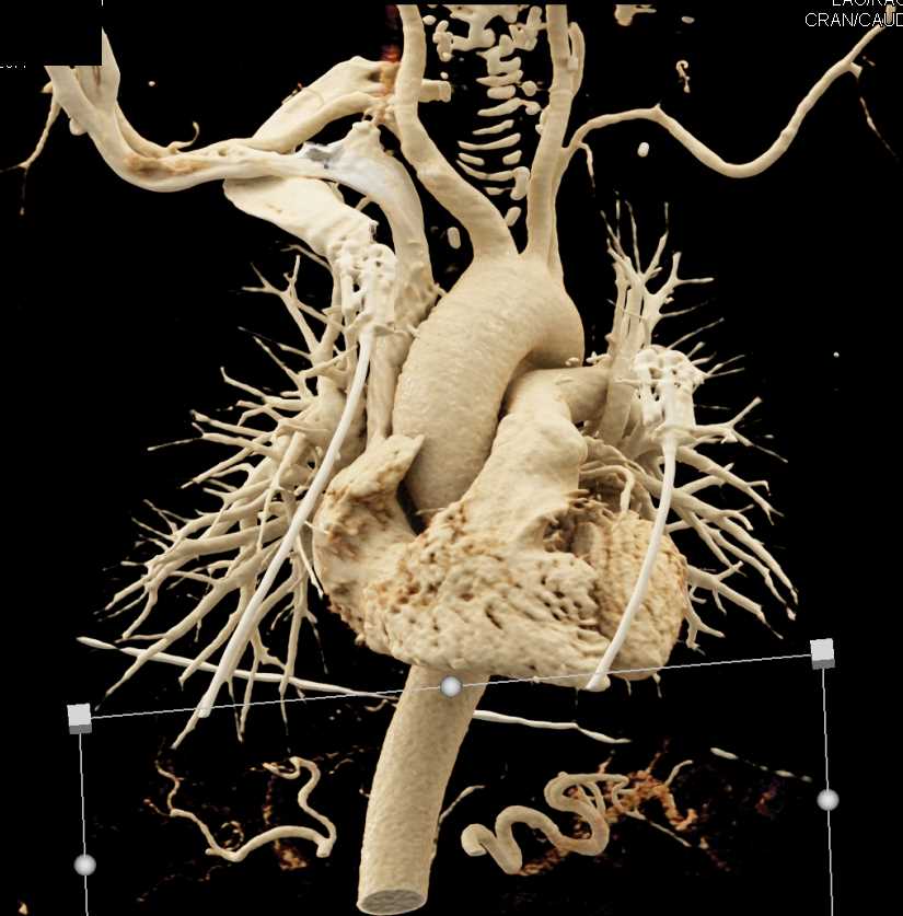 Branch Vessels off the Arch - CTisus CT Scan