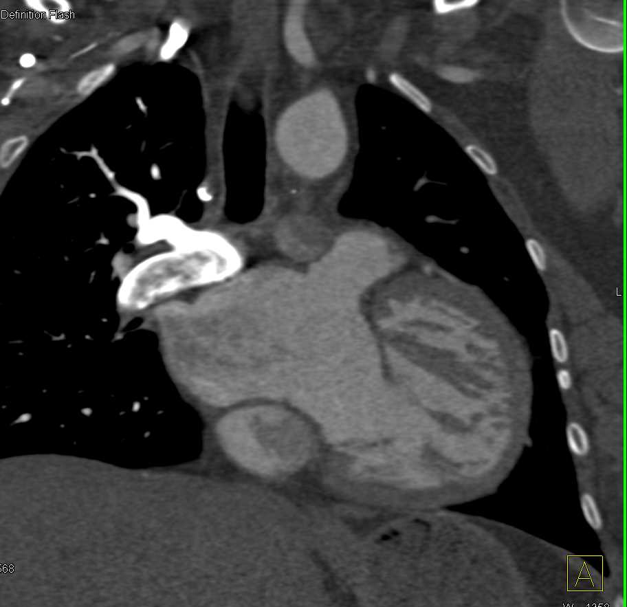 Pulmonary Embolism in Patient with Complex Cardiac Anomalies - CTisus CT Scan