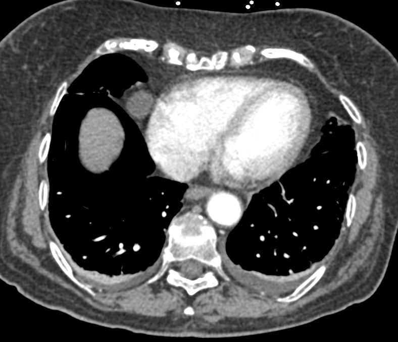 2cm Pericardial Cyst - CTisus CT Scan