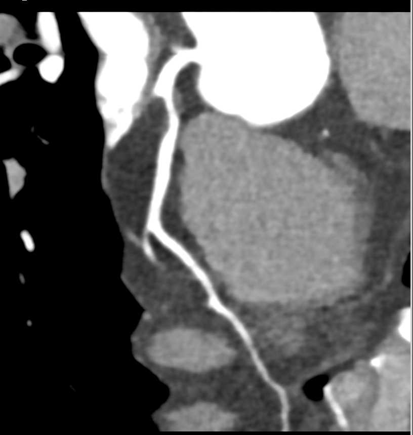CCTA with Left Anterior Descending Artery (LAD) Stenosis due to Non Calcified Plaque - CTisus CT Scan