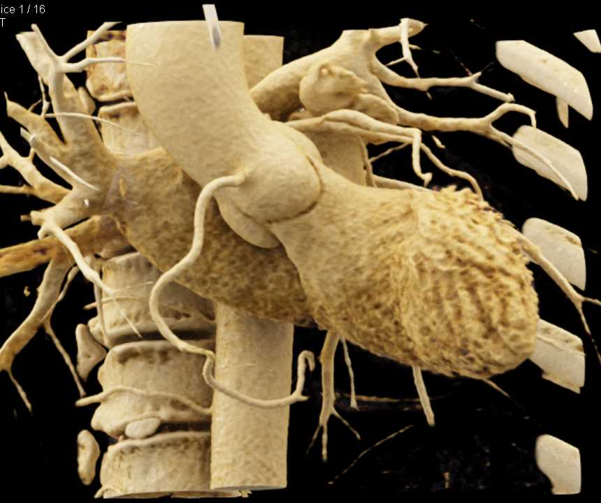CCTA with Stenosis of the Left Anterior Descending Artery (LAD) with Cinematic Rendering - CTisus CT Scan
