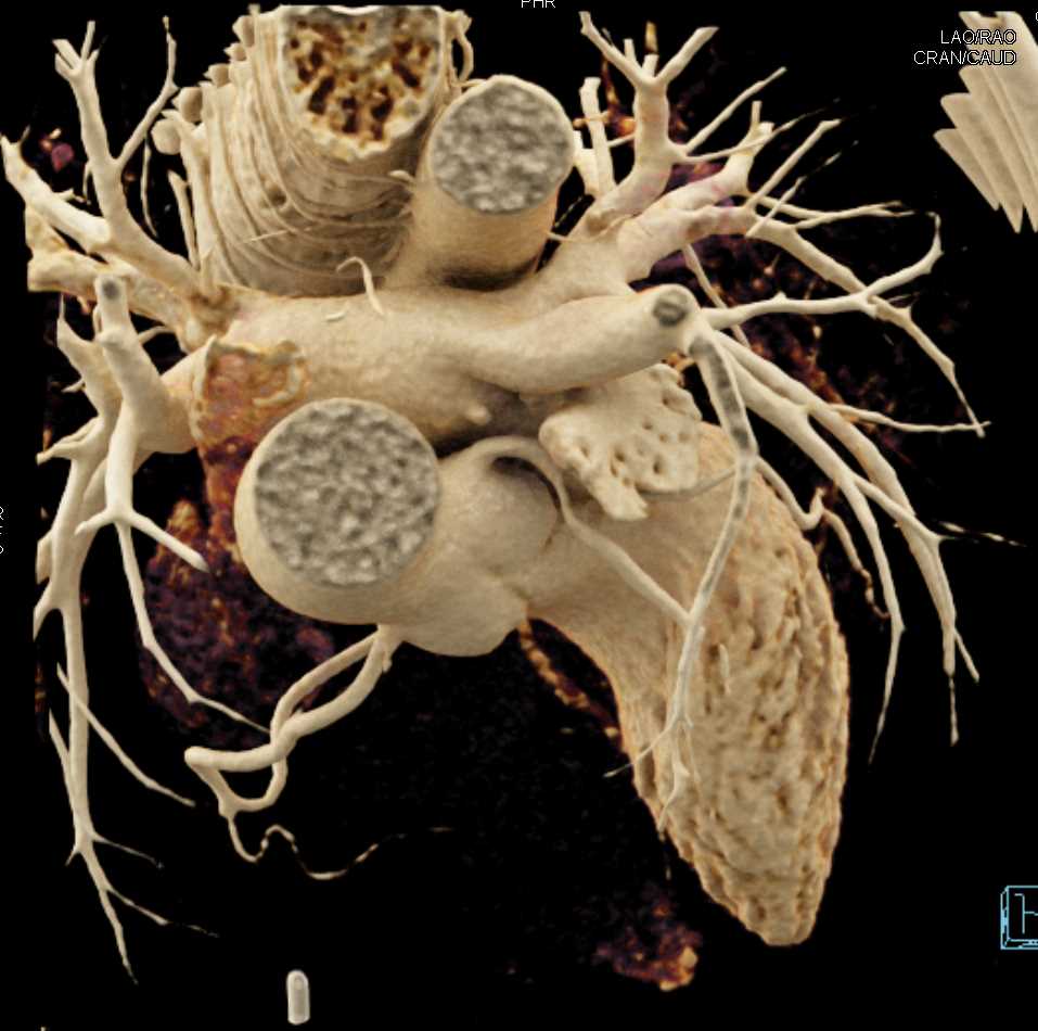 CCTA with Stenosis of the Left Anterior Descending Artery (LAD) with Cinematic Rendering - CTisus CT Scan