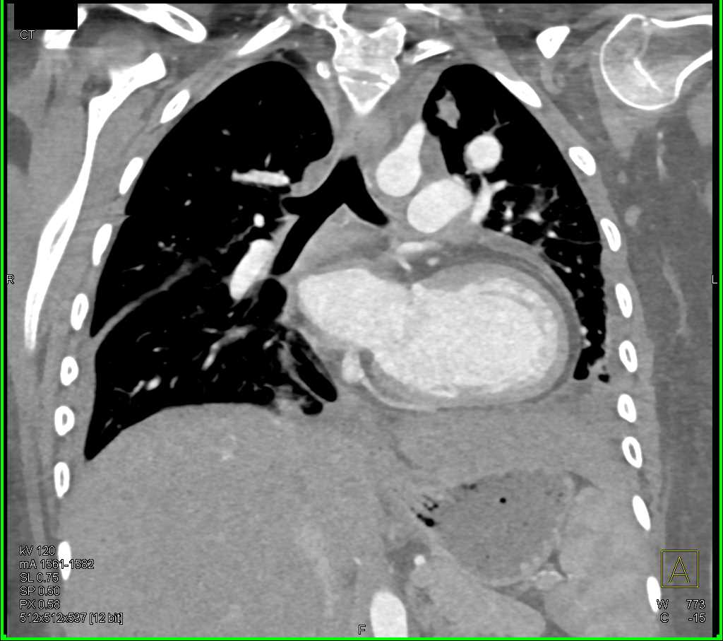 Dilated Left Ventricle - CTisus CT Scan