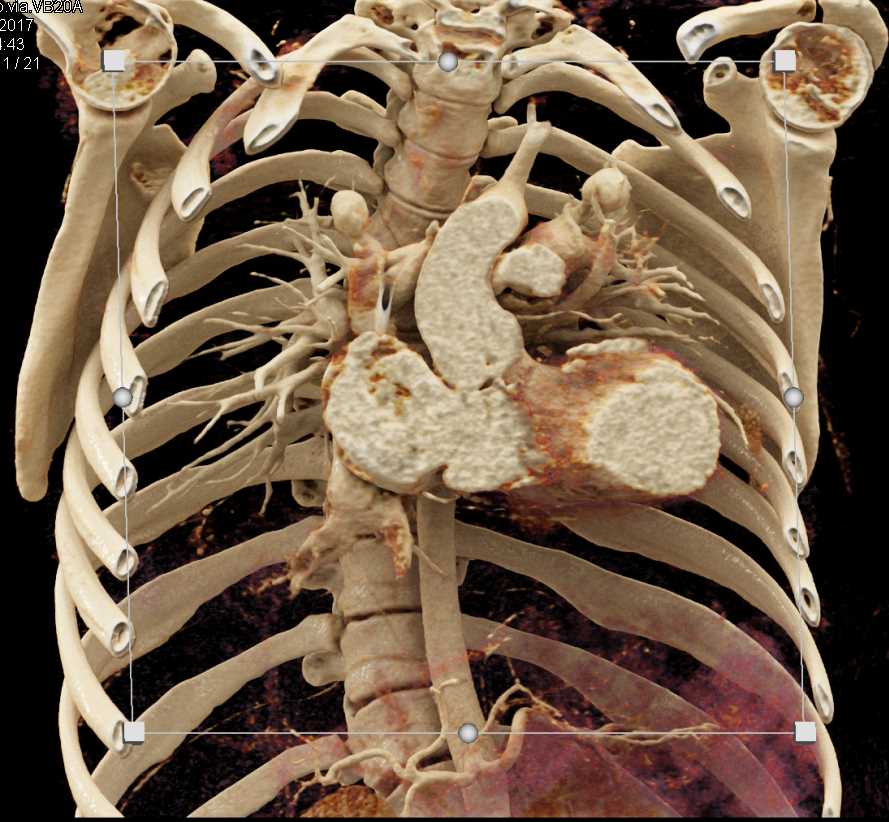 Dilated Left Ventricle - CTisus CT Scan