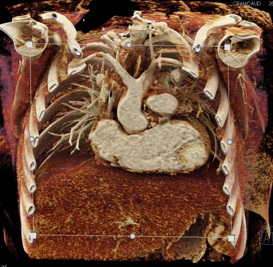 Dilated Left Ventricle - CTisus CT Scan