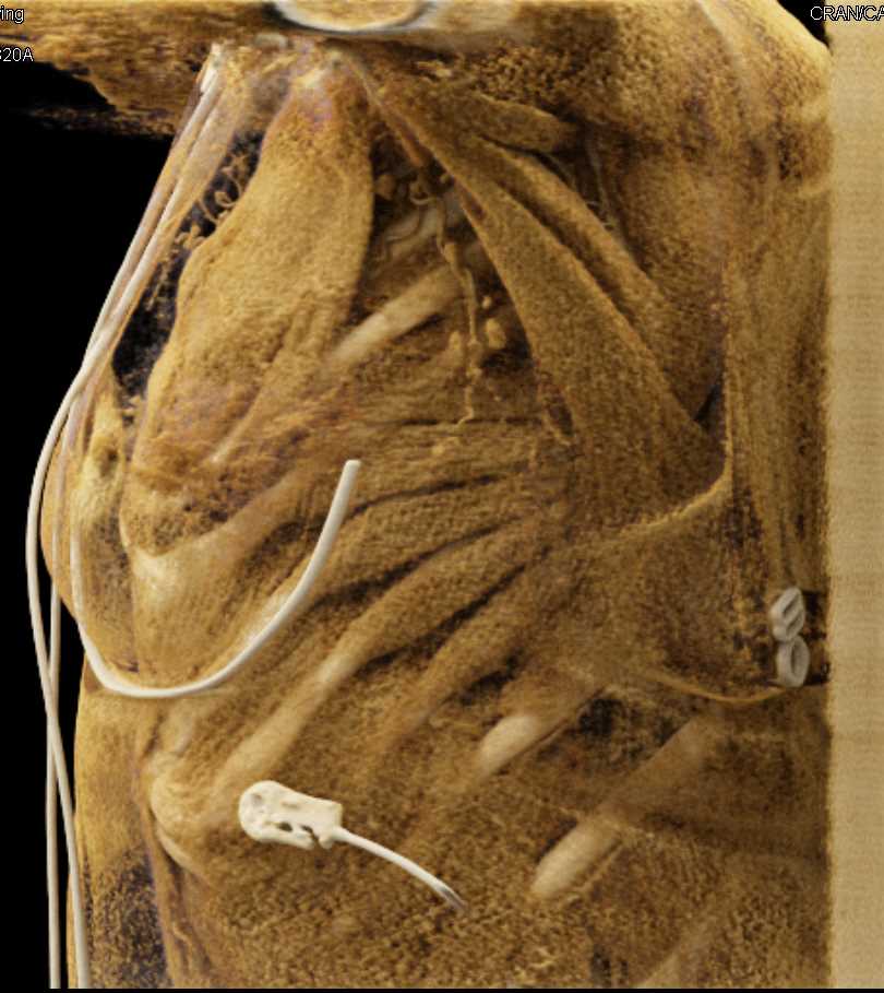 Left Atrial Appendage and Anatomy from a Sagittal View with Cinematic Rendering (CR) - CTisus CT Scan