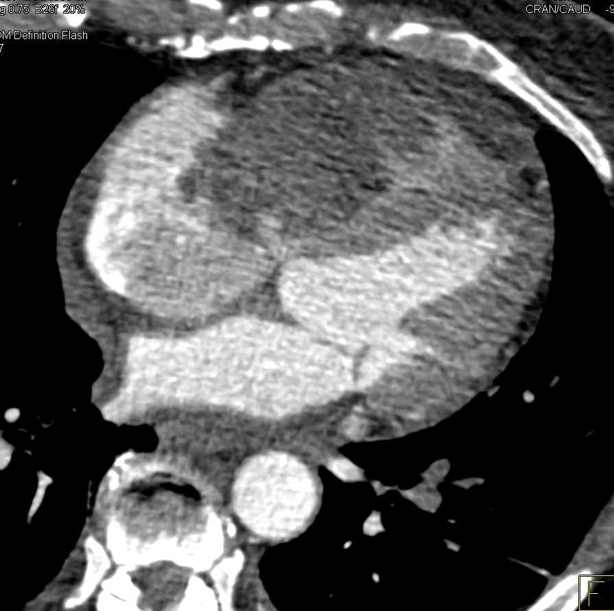 Cardiac Lymphoma - CTisus CT Scan