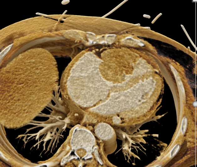 Cardiac Lymphoma - CTisus CT Scan