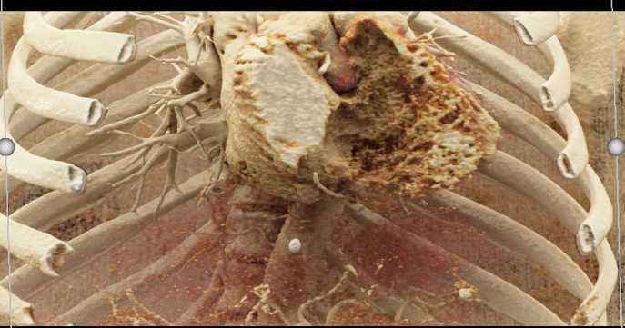 Cardiac Lymphoma - CTisus CT Scan