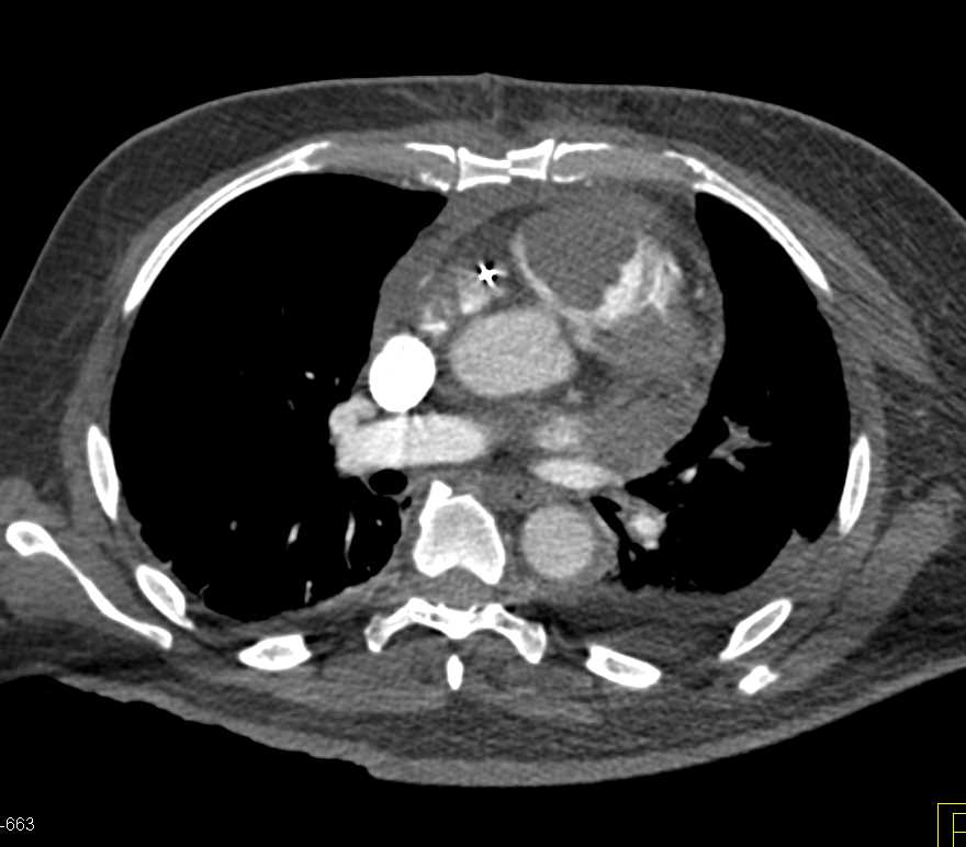 Metastatic Melanoma to Right Ventricle - CTisus CT Scan