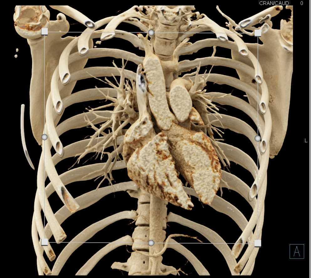 Cinematic Rendering of the Heart and Aorta - CTisus CT Scan