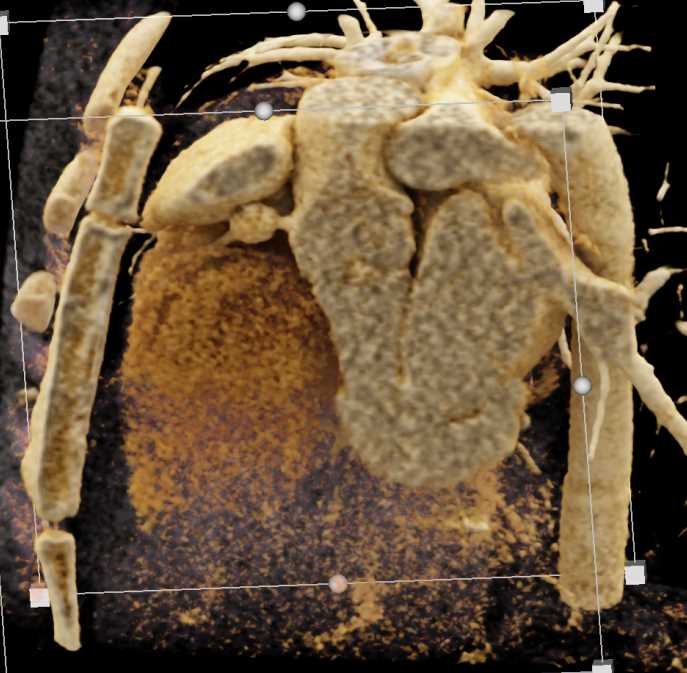 Right Coronary Artery Aneurysm - CTisus CT Scan