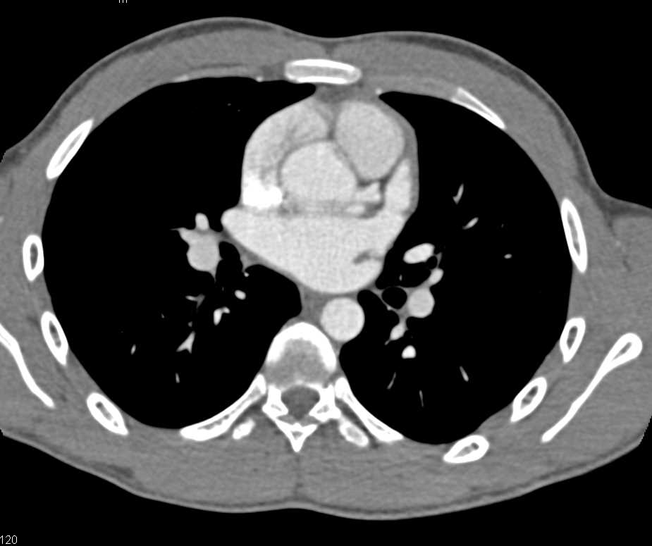 Aberrant Course of Circumflex Coronary Artery from Right Cusp - CTisus CT Scan