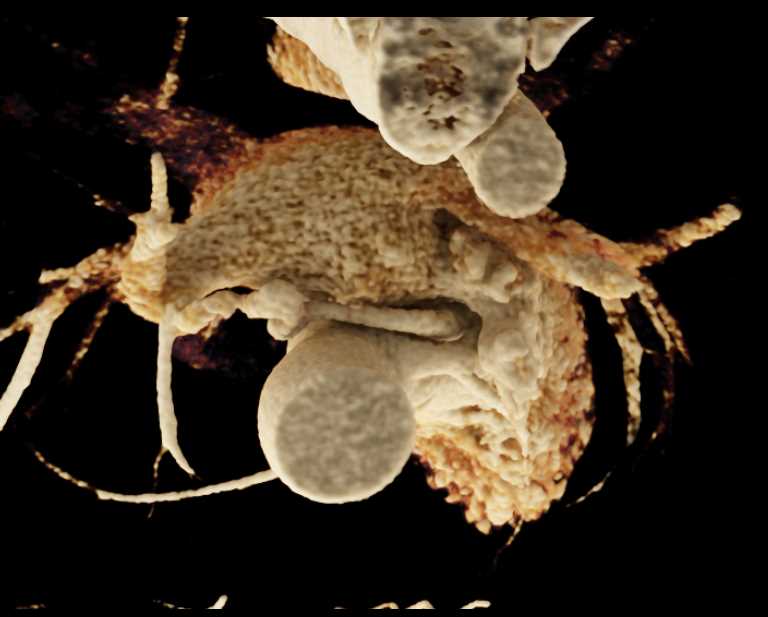 Aberrant Course of Circumflex Coronary Artery from Right Cusp - CTisus CT Scan