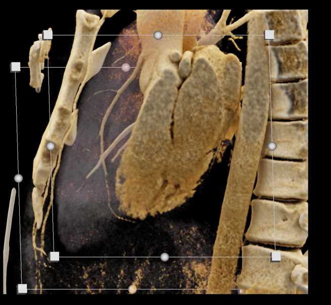 Aberrant Course of Circumflex Coronary Artery from Right Cusp - CTisus CT Scan