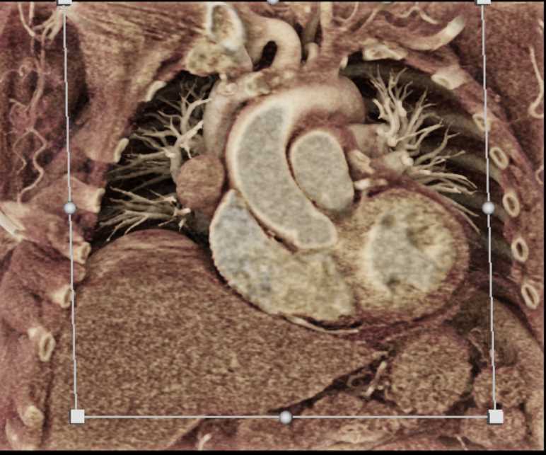 Pericardial Cyst - CTisus CT Scan