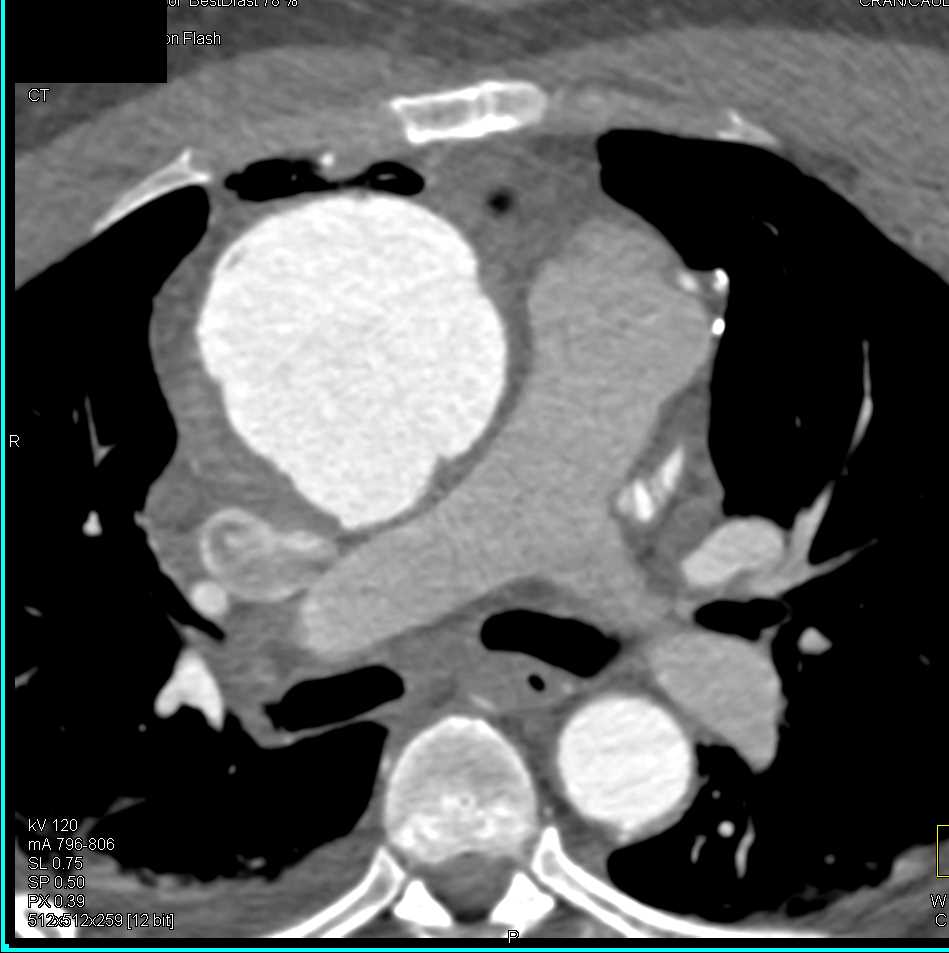 Pseudoaneurysm Ascending Aorta - CTisus CT Scan