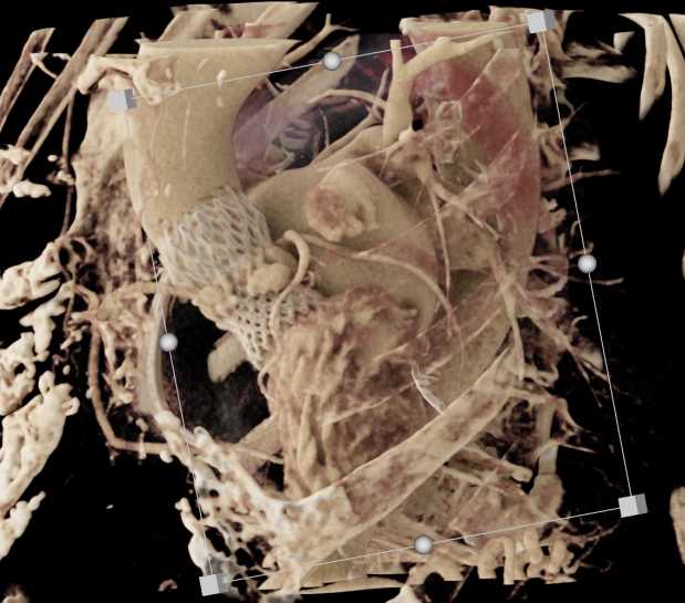 Post Transcatheter Aortic Valve Replacement (TAVR) Changes Aortic Valve with Cinematic Rendering (CR) - CTisus CT Scan