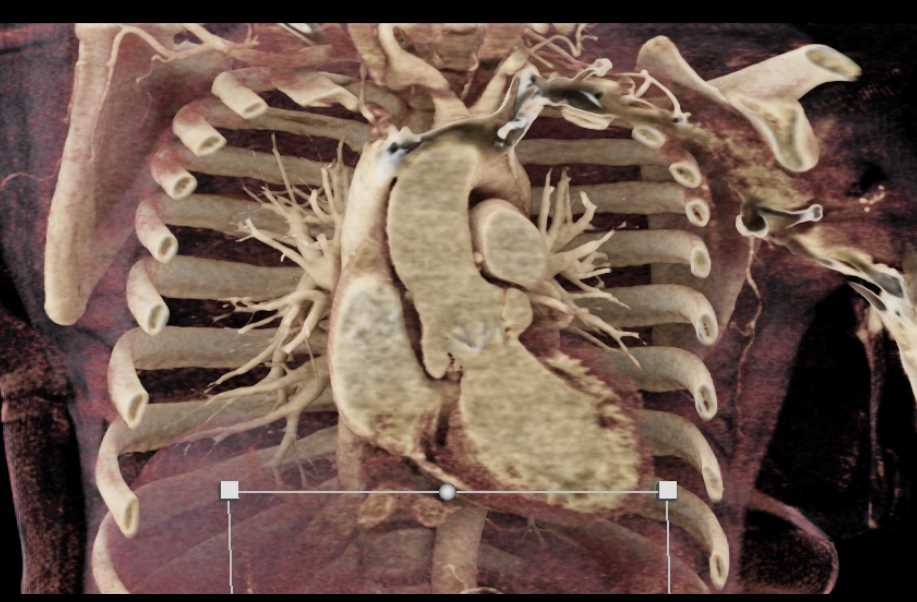 AVR with Dilated Coronary Arteries - CTisus CT Scan
