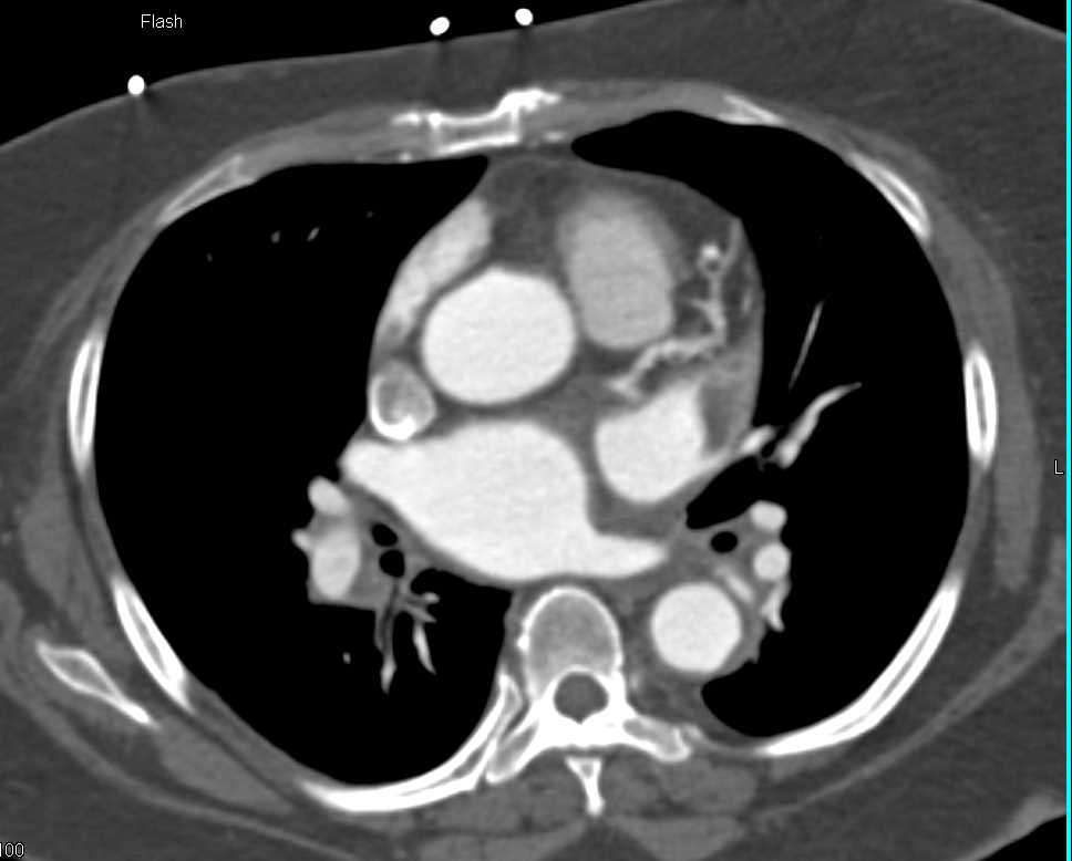 Thrombus Left Atrial Appendage and Distal Clots - CTisus CT Scan