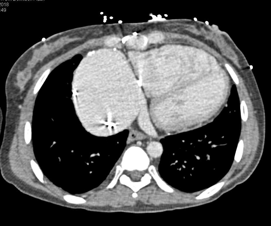 Enlarged Right Atrium - CTisus CT Scan