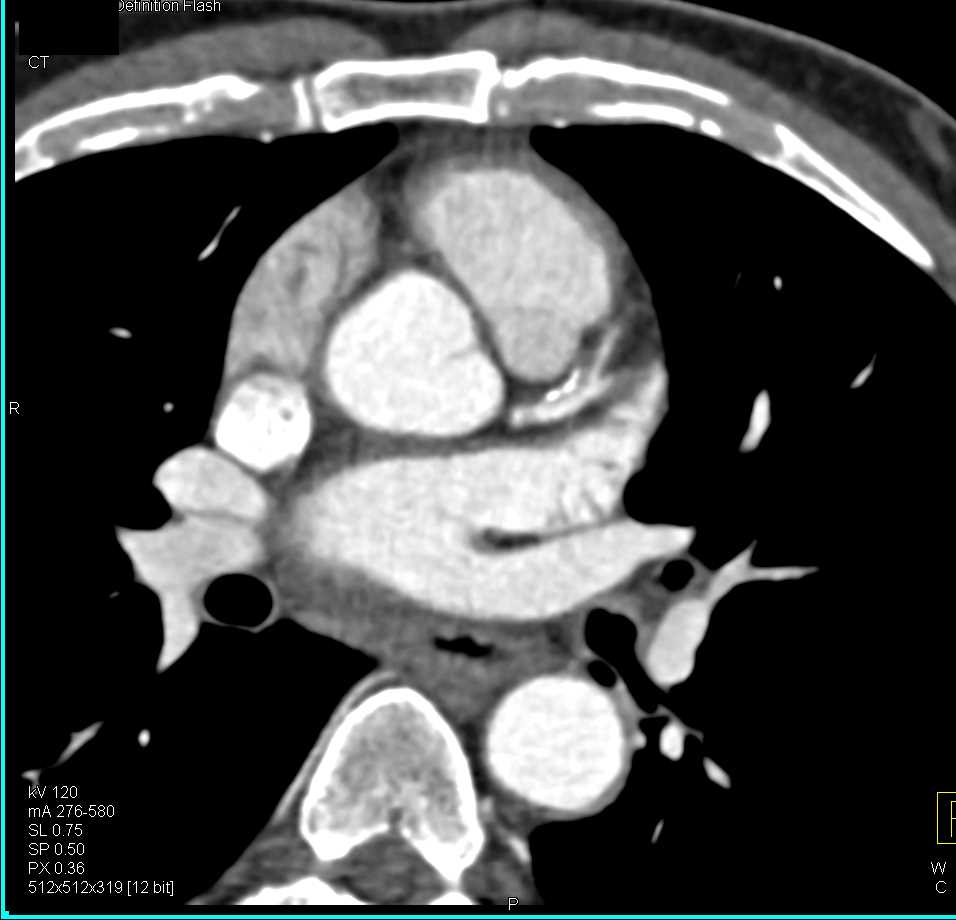 Calcified Plaque in the LAD - CTisus CT Scan