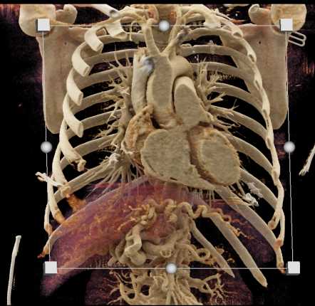 CR Mapping of the Left Ventricle - CTisus CT Scan