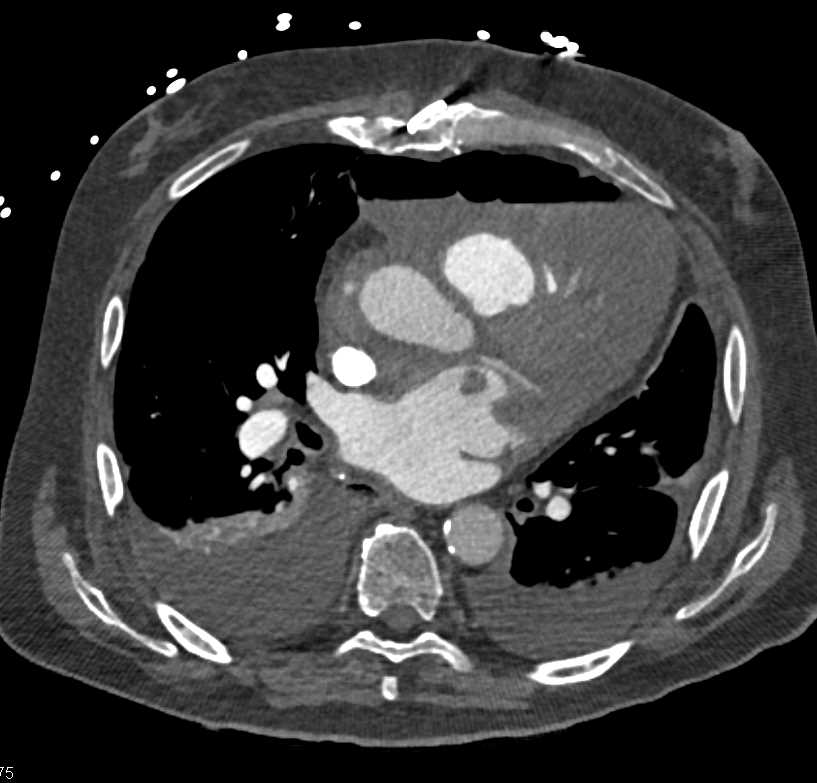 CTisus CT Scanning | Post Cardiac Surgery Changes