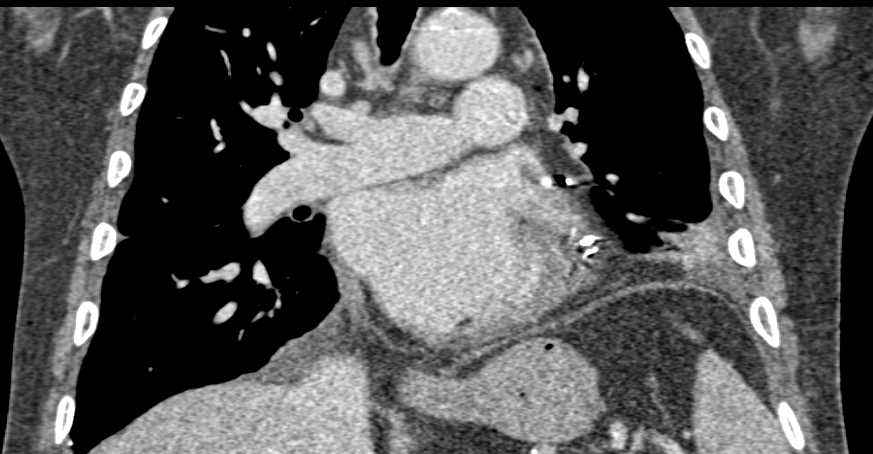 Post Cardiac Surgery Changes - CTisus CT Scan