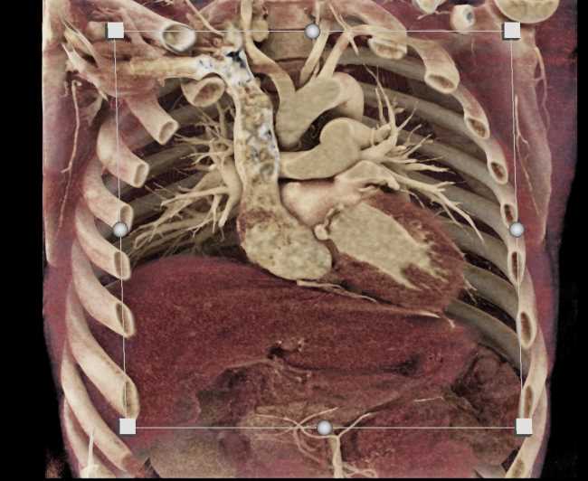 CTisus CT Scanning | Aortic Valve Repair