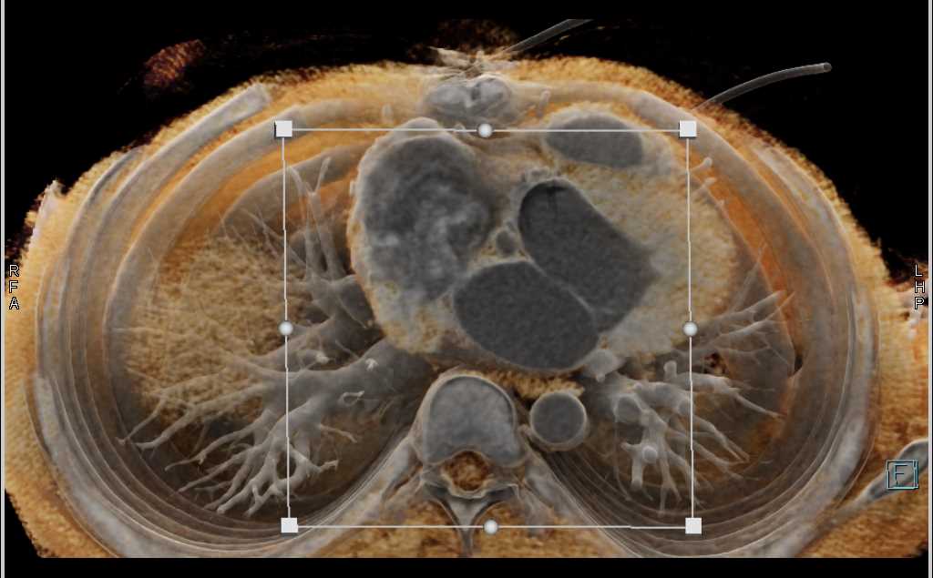 Aortic Valve Repair - CTisus CT Scan
